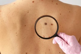 Skin Cancer & Sarcoma